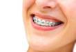 4 этапа, как крепятся брекеты к зубам