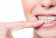 6 распространенных случаев, когда ставят брекеты на зубы