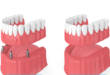 Съемные и несъемные зубные протезы: полный обзор