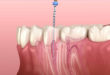 6 последствий удаления нерва из зуба