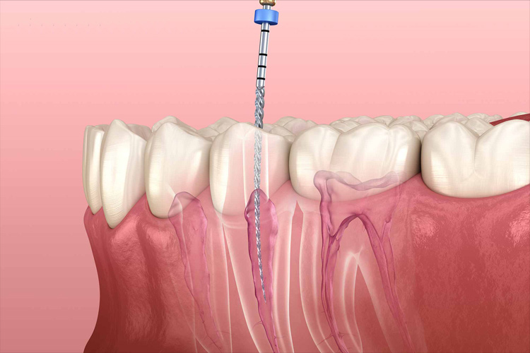 6 последствий удаления нерва из зуба