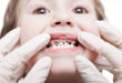 9 правдивых фактов про лечение передних зубов серебром у детей