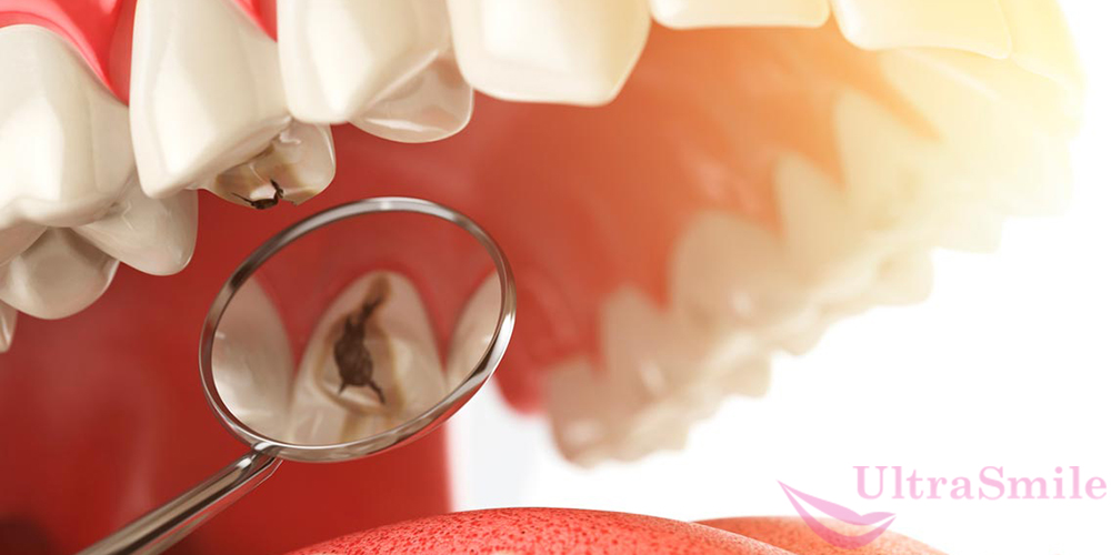 Кариес – одна из самых распространенных стоматологических патологий