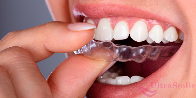 Элайнеры «ФлексиЛайнер», можно носить людям с постоянными зубами – это взрослые, подростки от 12-14 лет