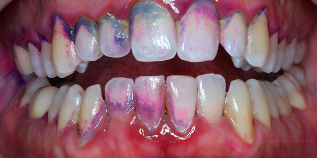Стоматологи используют специальные индикаторы окрашивания, которые подсвечивают зубной камень и отложения