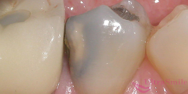 Кариес – это одно из самых распространенных стоматологических заболеваний.