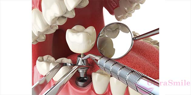 Дентальная имплантация – это метод восстановления отсутствующих зубов, при котором на место живого корня устанавливают его титановый аналог