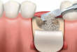 Что такое остеопластика в стоматологии, методы