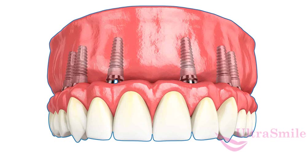 Базальная имплантация зубов это метод комплексного восстановления зубов посредствам протезирования на имплантах