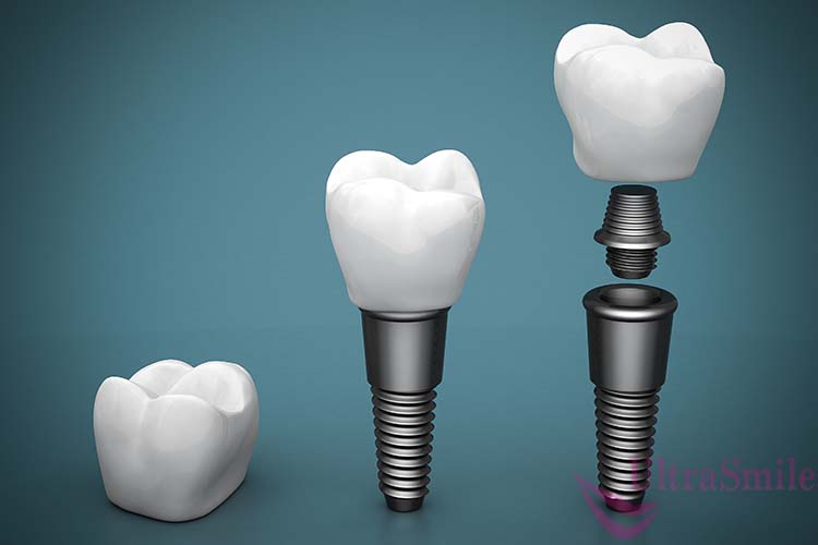 Виды имплантов зубов и 5 популярных брендов