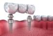 Базальная имплантация зубов, мифы и факты