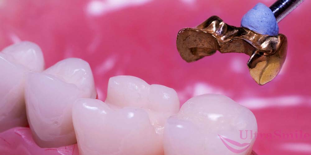 Микропротезирование – еще одно направление в ортопедической стоматологии, которое относится к несъемным решениям