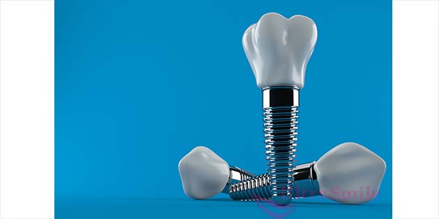 Зубной имплант – это титановой аналог зубного корня