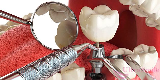 Имплантация – лучший вариант восстановления зубов в большинстве случаев частичной и полной адентии