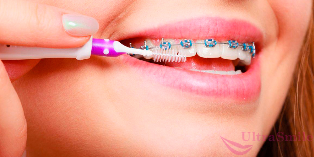 Если чистить зубы небрежно, то налет и зубной камень оседает на любых видах брекетов