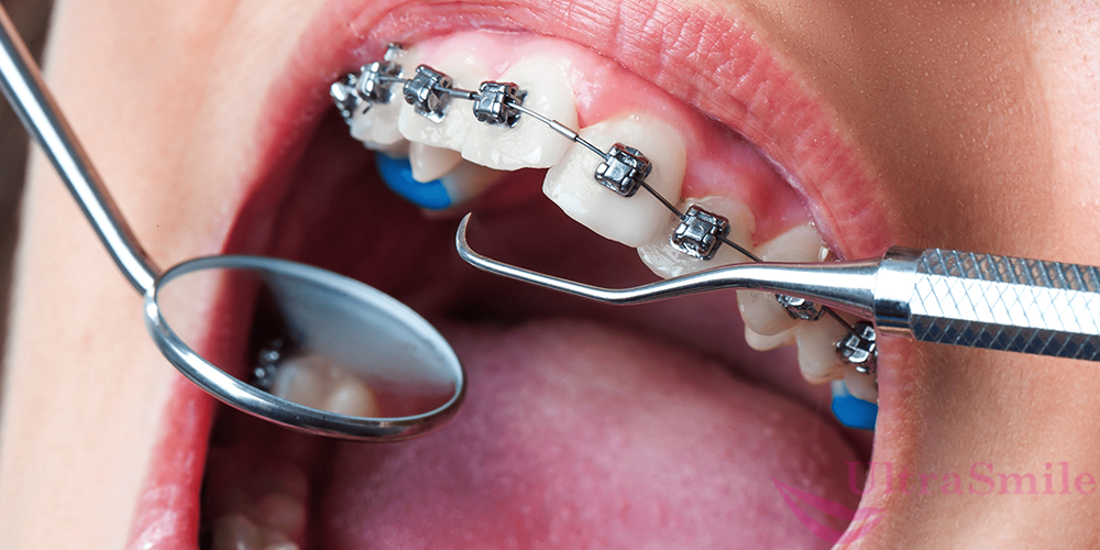 После установки ортодонтических аппаратов дикция меняется у большинства пациентов