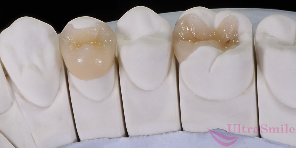 керамические вкладки на зубы