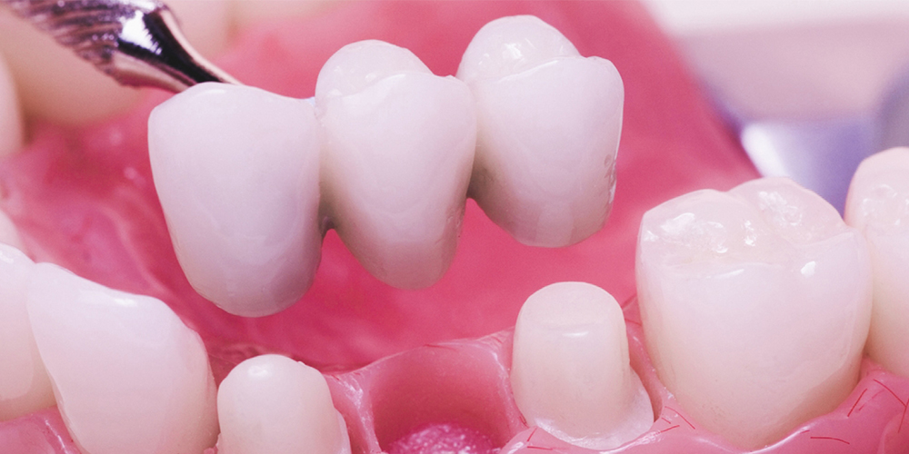 Зубной мост на 2 зуба: виды, показания, цена