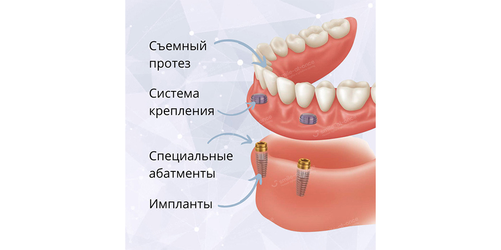 Условно-съемные протезы на имплантах – это ортопедические конструкции, которые можно и нужно снимать самостоятельно Фото: Smile-at-Once.ru.