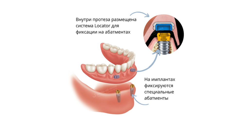 Так выглядит система Locator для фиксации условно-съемных протезов на импланты. Фото: Smile-at-Once.ru.