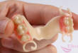 Зубные протезы «Квадротти»: отзывы