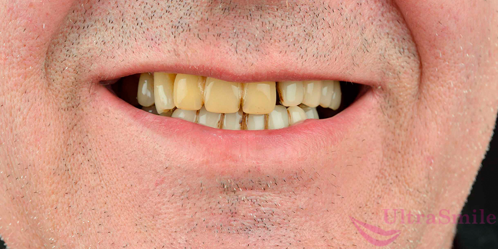 Желтизна зубов – из-за неправильного питания
