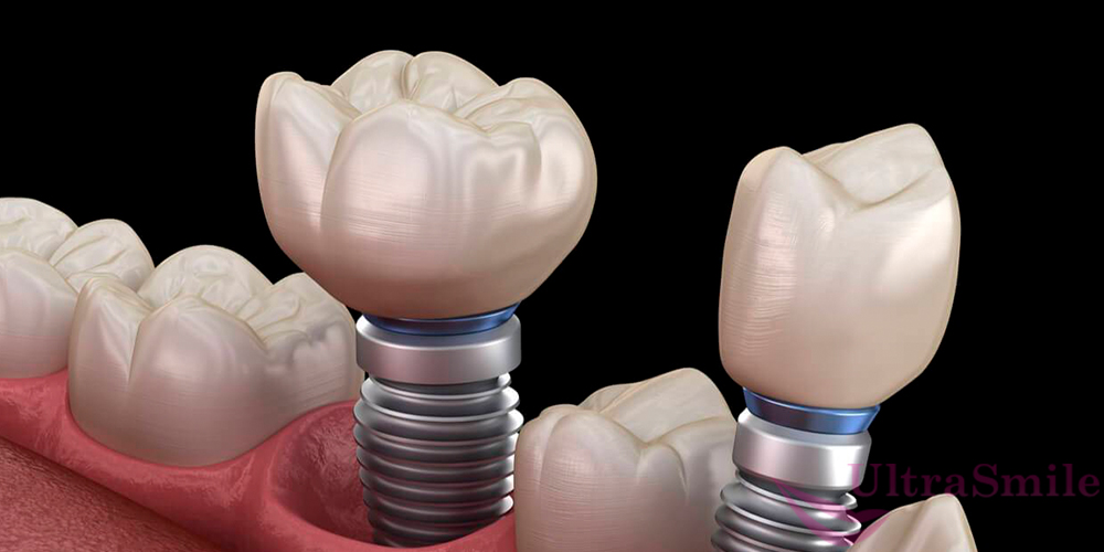 Восстановление зубов на имплантах