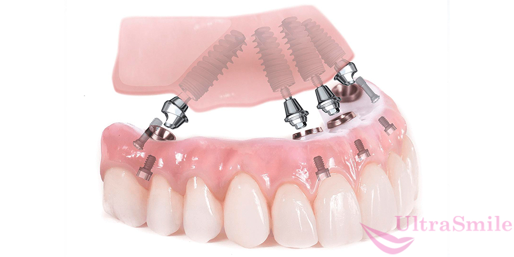 Имплантация полностью восстанавливает отсутствующий зуб – корень и коронку.